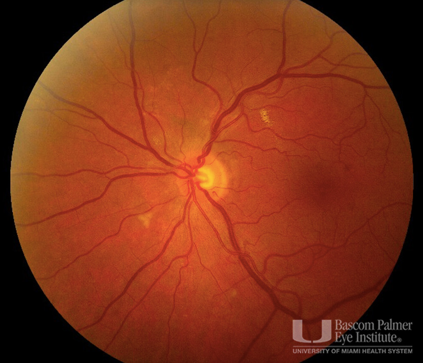 Gemcitabine induced Purstchers like retinopathy in both eyes