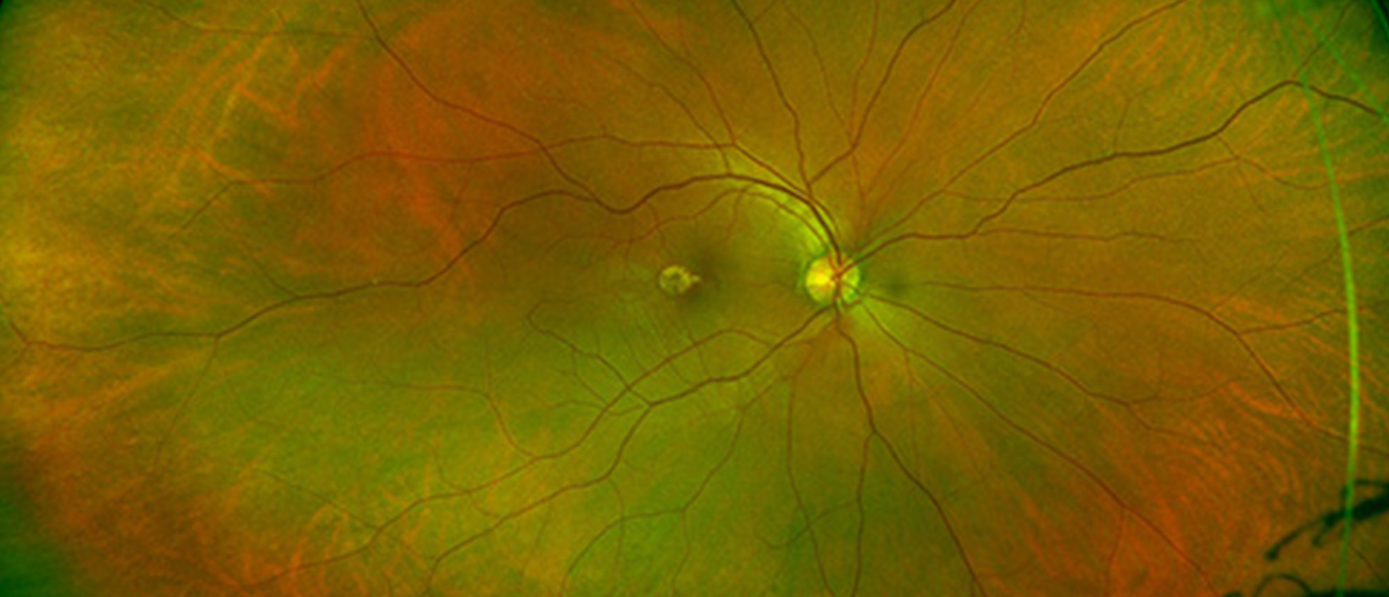 Macular Choroidal Neovascularization (CNV) Secondary to Punctate Inner Choroiditis