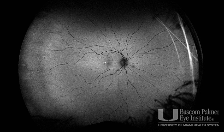 Macular Choroidal Neovascularization (CNV) Secondary to Punctate Inner Choroiditis