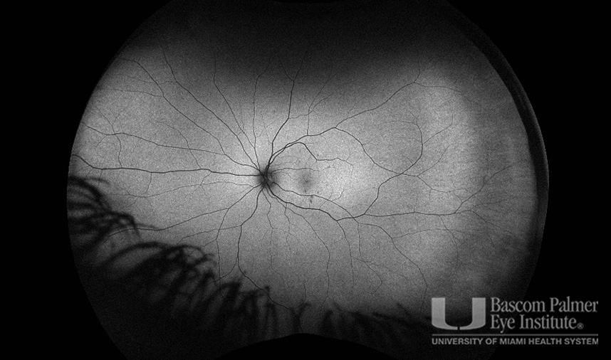 Macular Choroidal Neovascularization (CNV) Secondary to Punctate Inner Choroiditis