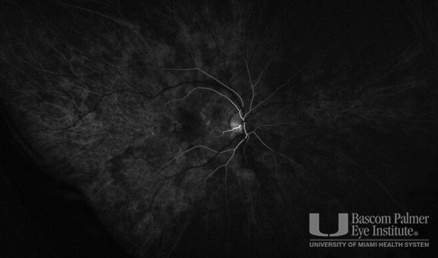 Macular Choroidal Neovascularization (CNV) Secondary to Punctate Inner Choroiditis