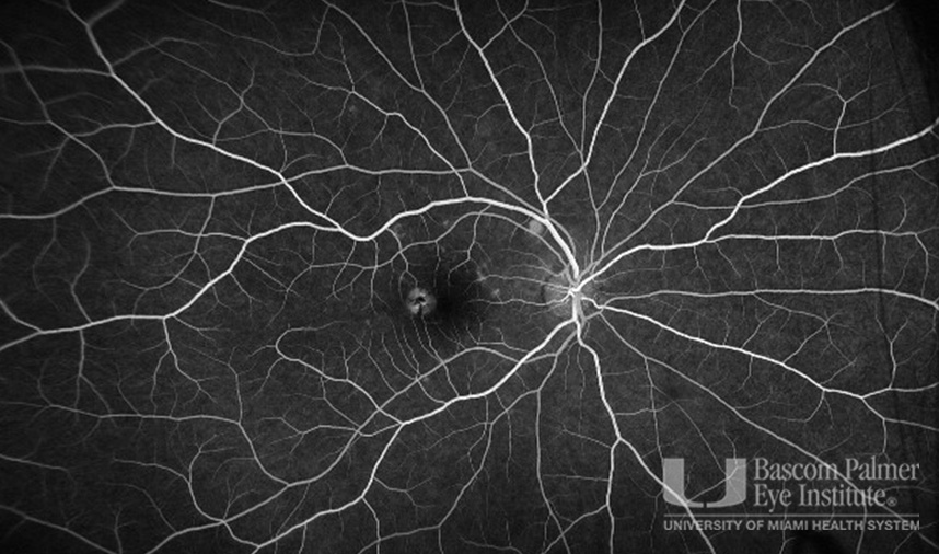 Macular Choroidal Neovascularization (CNV) Secondary to Punctate Inner Choroiditis