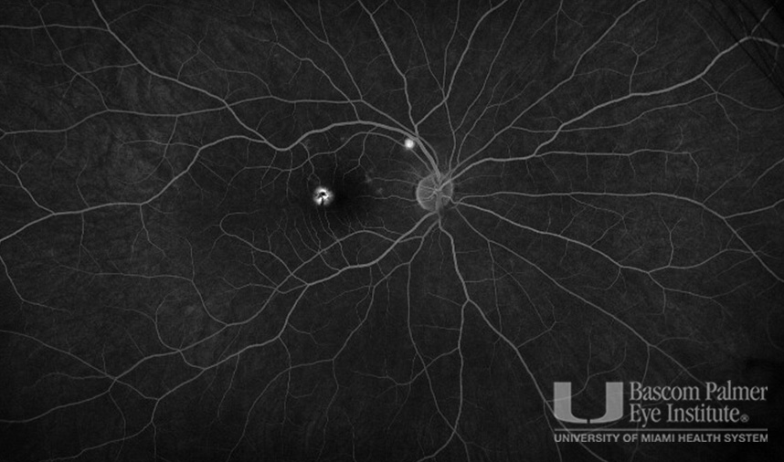 Macular Choroidal Neovascularization (CNV) Secondary to Punctate Inner Choroiditis