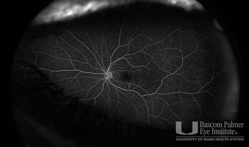 Macular Choroidal Neovascularization (CNV) Secondary to Punctate Inner Choroiditis