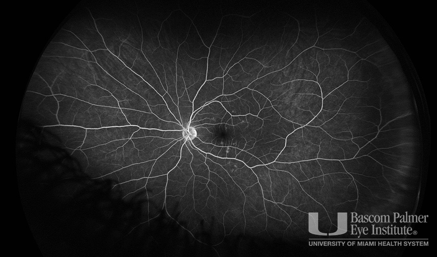 Macular Choroidal Neovascularization (CNV) Secondary to Punctate Inner Choroiditis