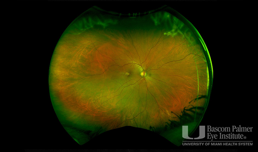 Macular Choroidal Neovascularization (CNV) Secondary to Punctate Inner Choroiditis