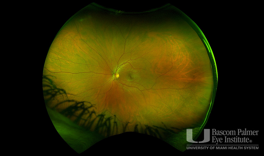 Macular Choroidal Neovascularization (CNV) Secondary to Punctate Inner Choroiditis
