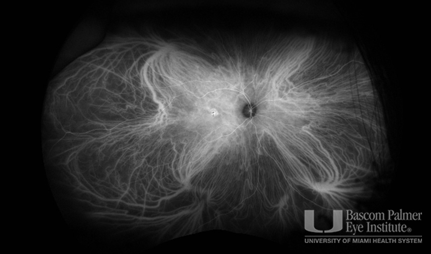 Macular Choroidal Neovascularization (CNV) Secondary to Punctate Inner Choroiditis