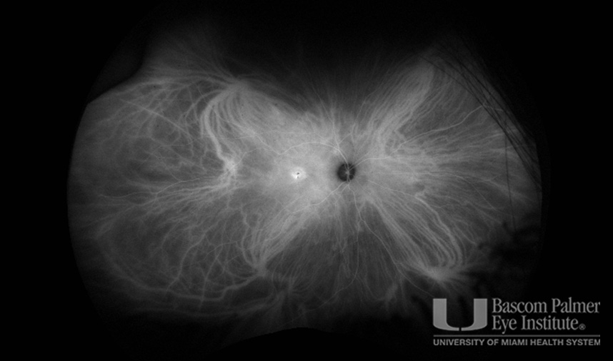 Macular Choroidal Neovascularization (CNV) Secondary to Punctate Inner Choroiditis