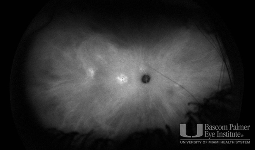 Macular Choroidal Neovascularization (CNV) Secondary to Punctate Inner Choroiditis