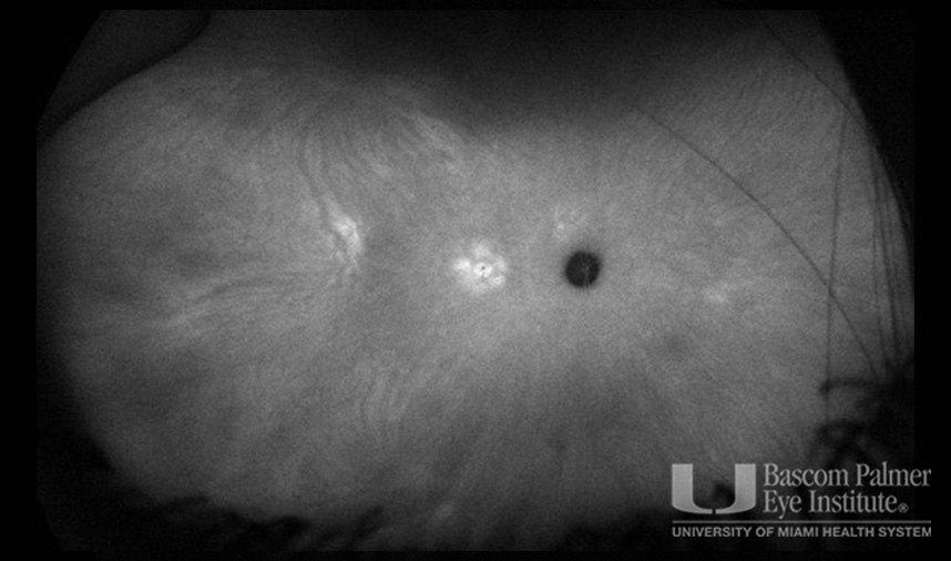 Macular Choroidal Neovascularization (CNV) Secondary to Punctate Inner Choroiditis