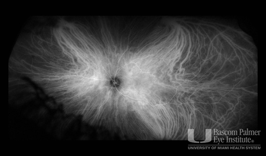 Macular Choroidal Neovascularization (CNV) Secondary to Punctate Inner Choroiditis