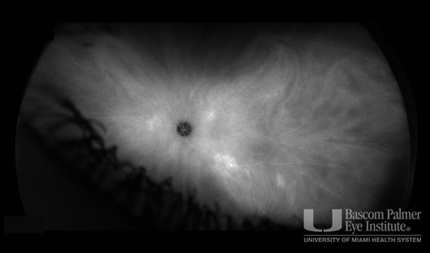 Macular Choroidal Neovascularization (CNV) Secondary to Punctate Inner Choroiditis