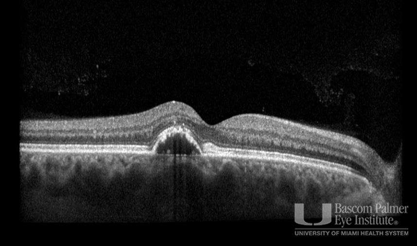 Macular Choroidal Neovascularization (CNV) Secondary to Punctate Inner Choroiditis