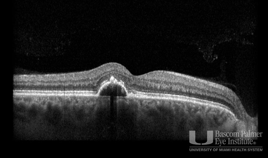 Macular Choroidal Neovascularization (CNV) Secondary to Punctate Inner Choroiditis