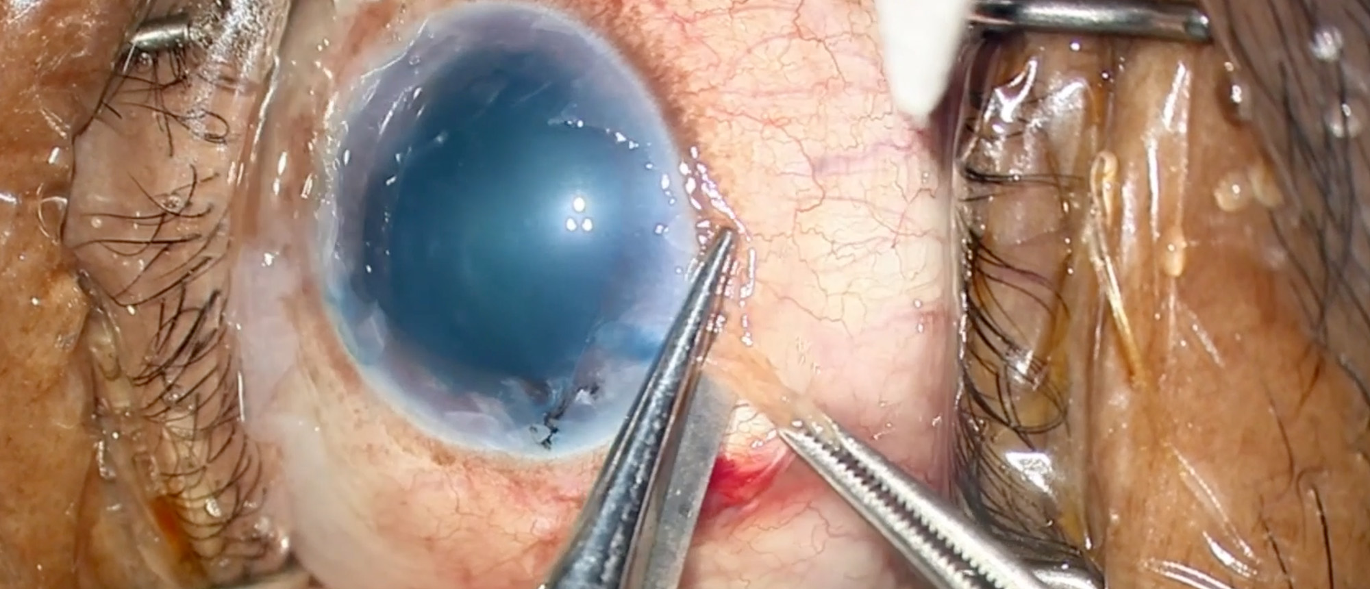 Intraoperative Aqueous Misdirection