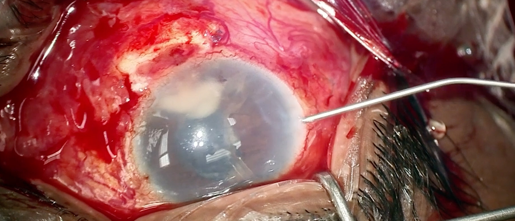 Mycobacterium Abscessus Endophthalmitis
