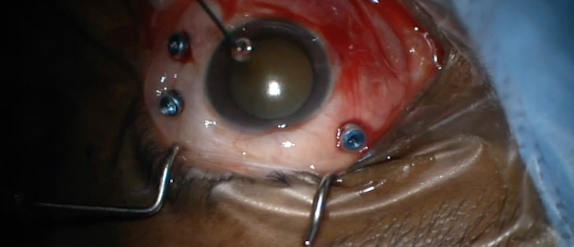 Leukemic Retinopathy