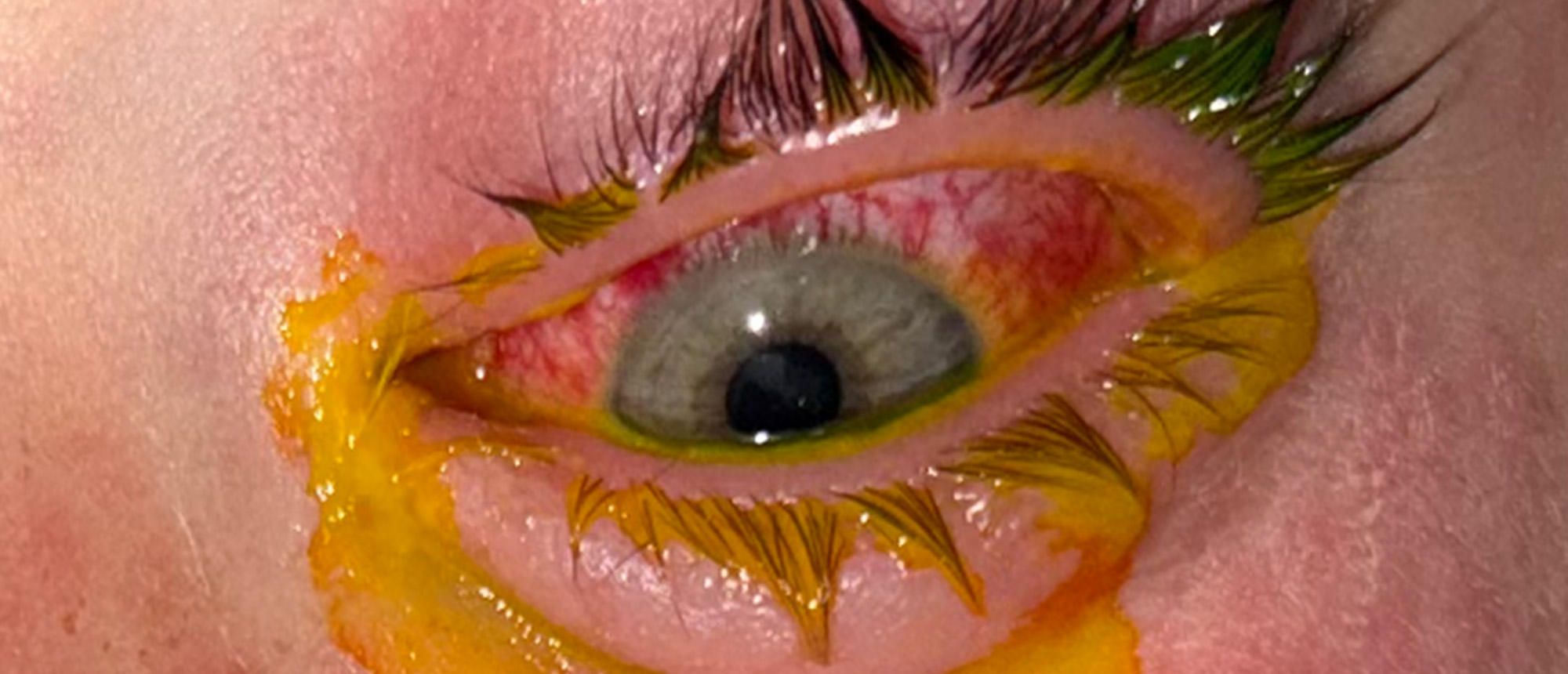 Stevens-Johnson Syndrome / Mycoplasma Induced Rash and Mucositis