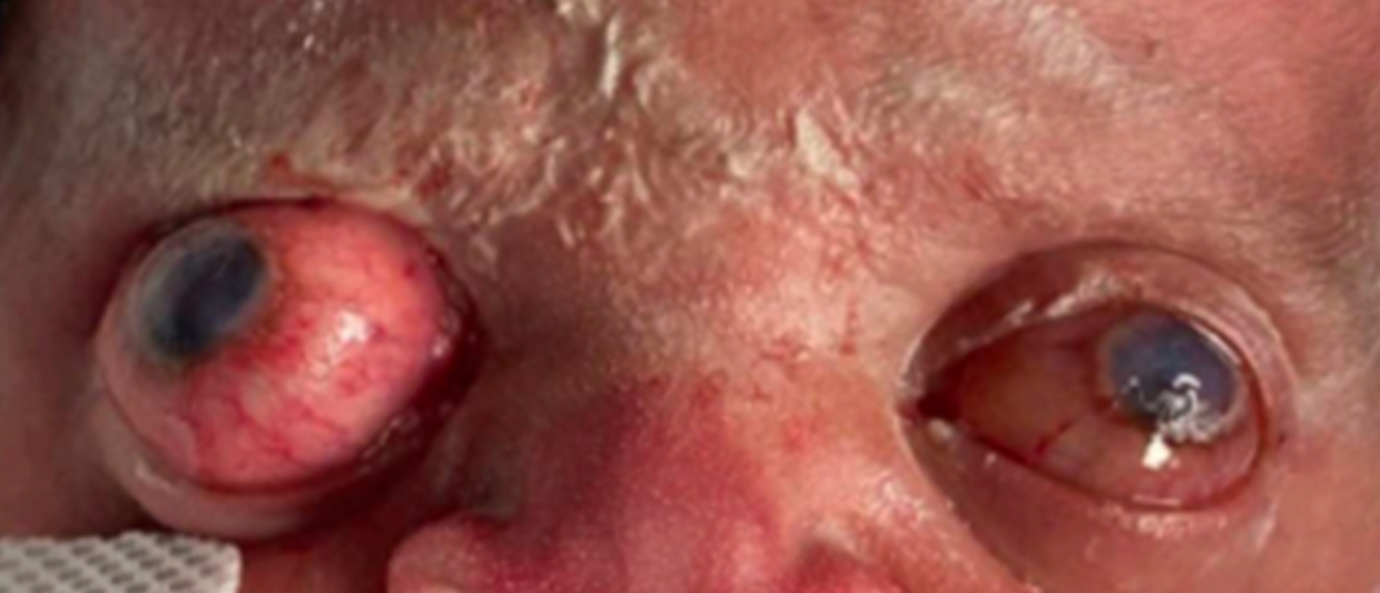 Total Globe Subluxation Secondary to Pfeiffer Syndrome Type II