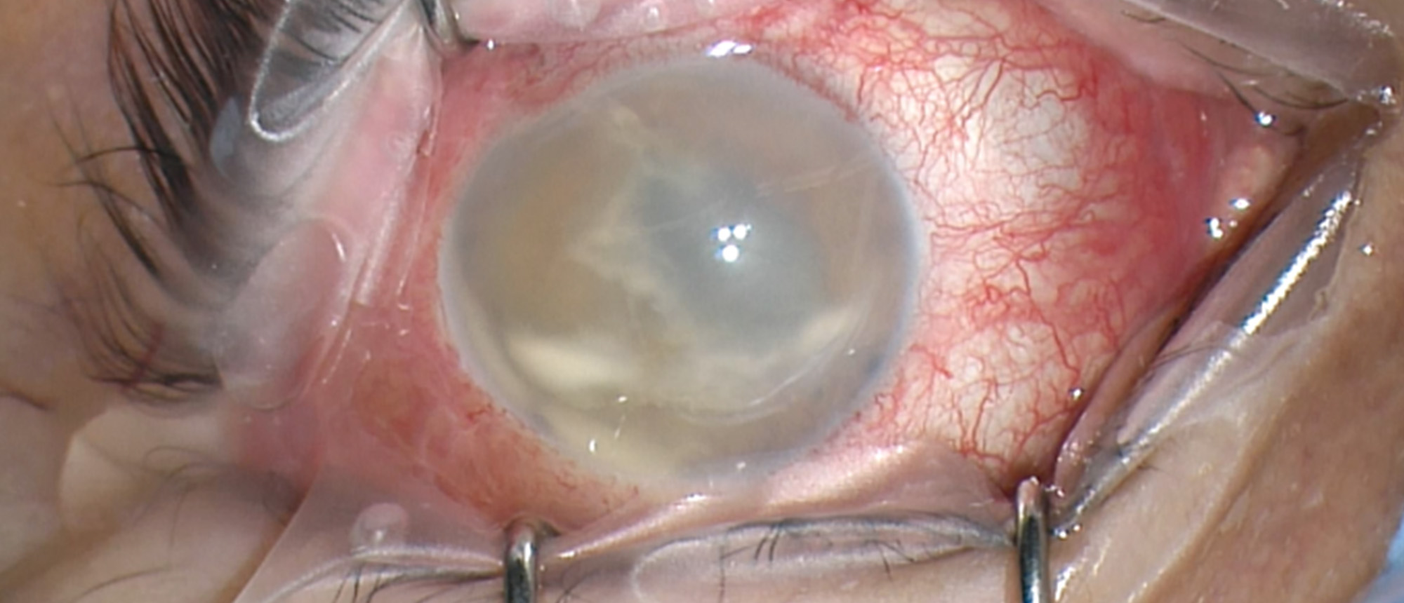 Tube-Associated Endophthalmitis