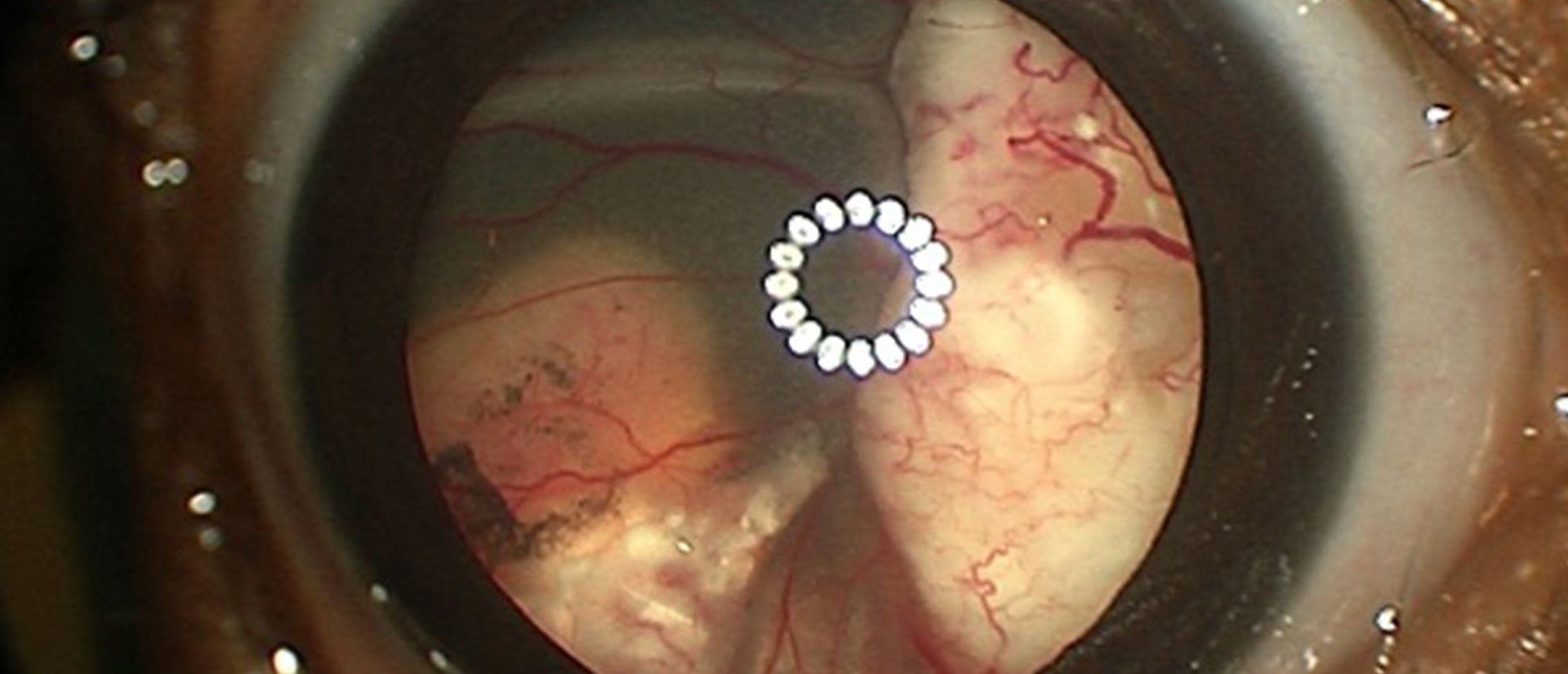 Bilateral Retinoblastoma