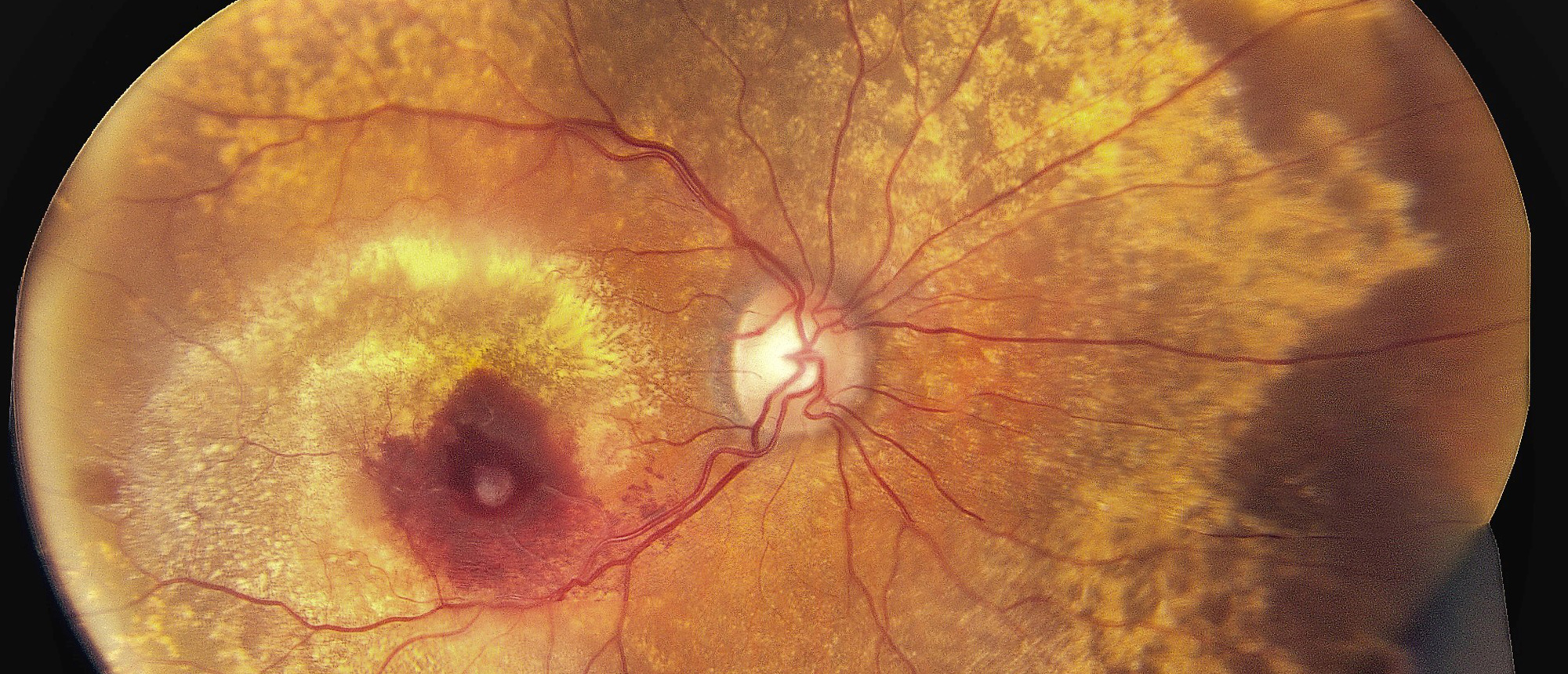 Familial Drusen with Choroidal Neovascularization