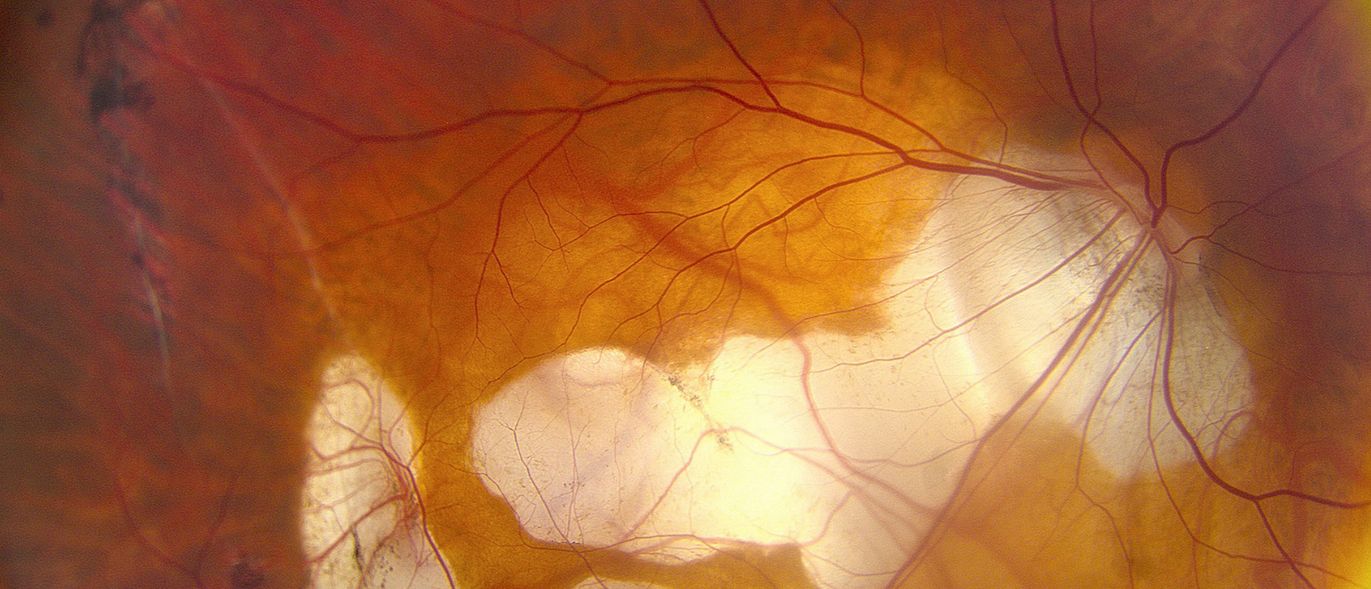 Myopic Degeneration