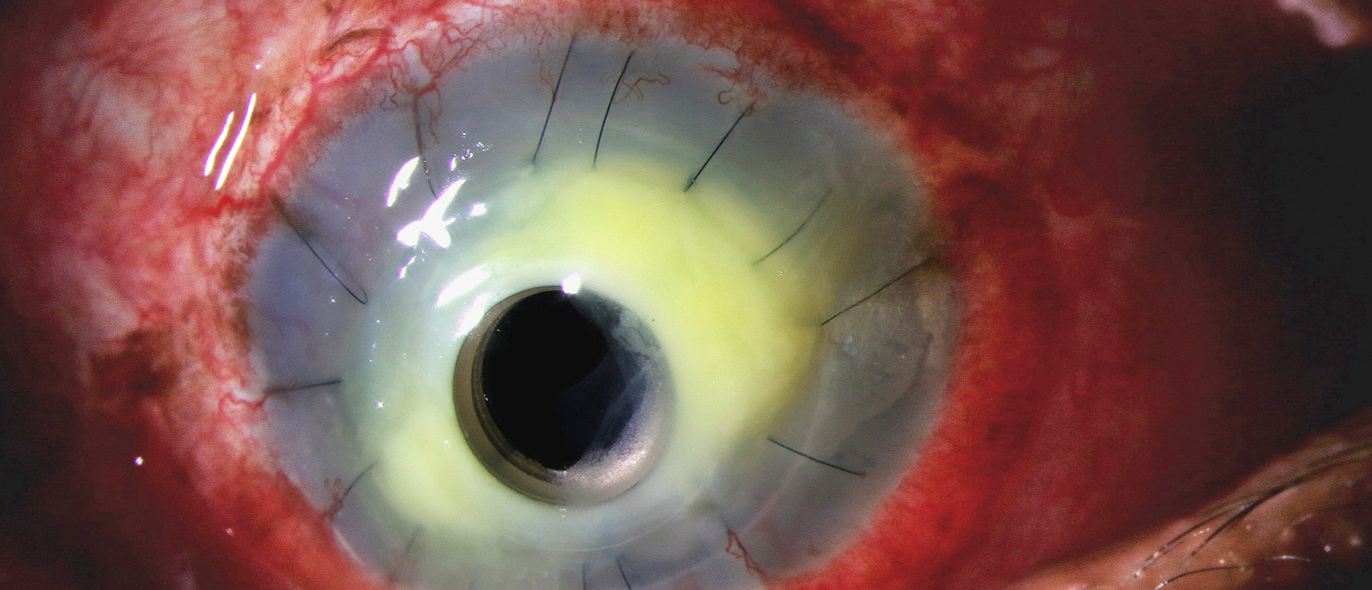 Keratoprosthesis Endophthalmitis