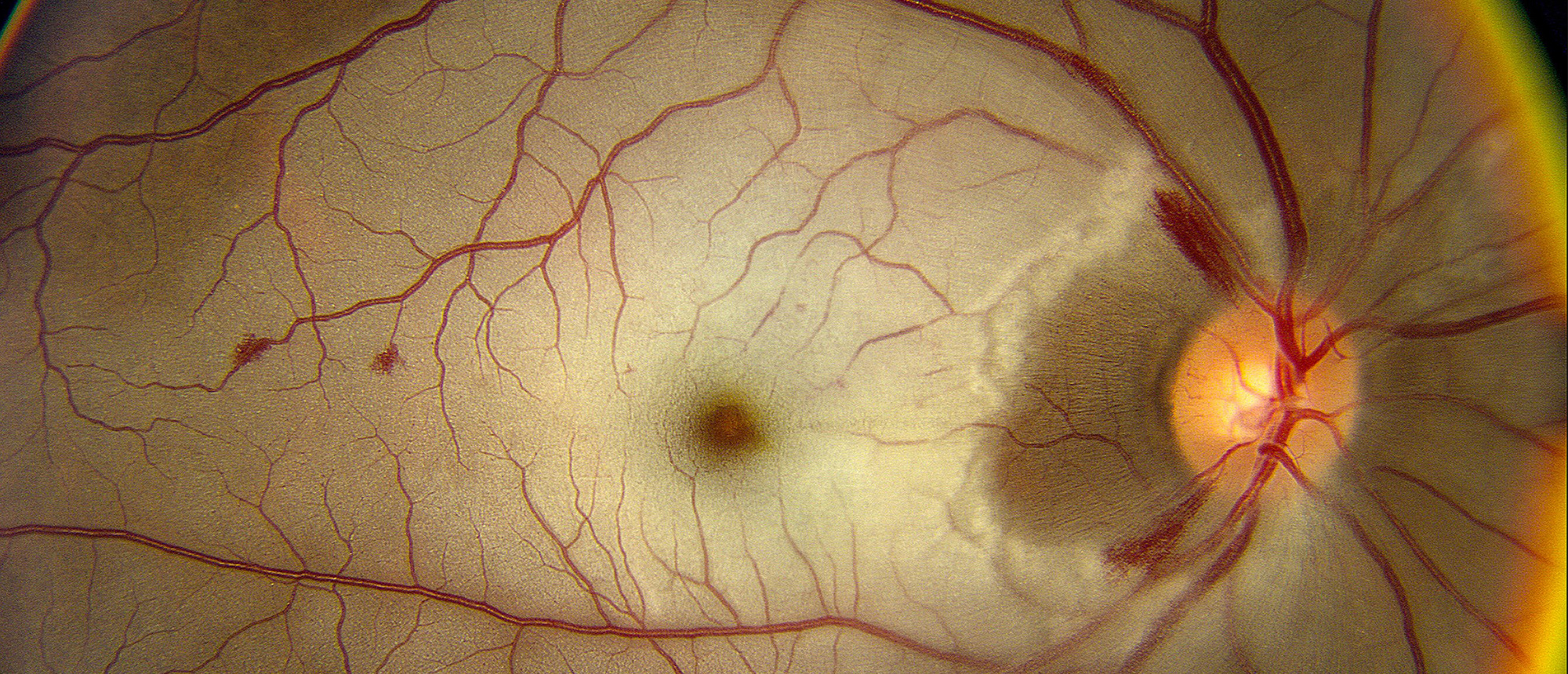 Bilateral Retinal Artery Occlusions