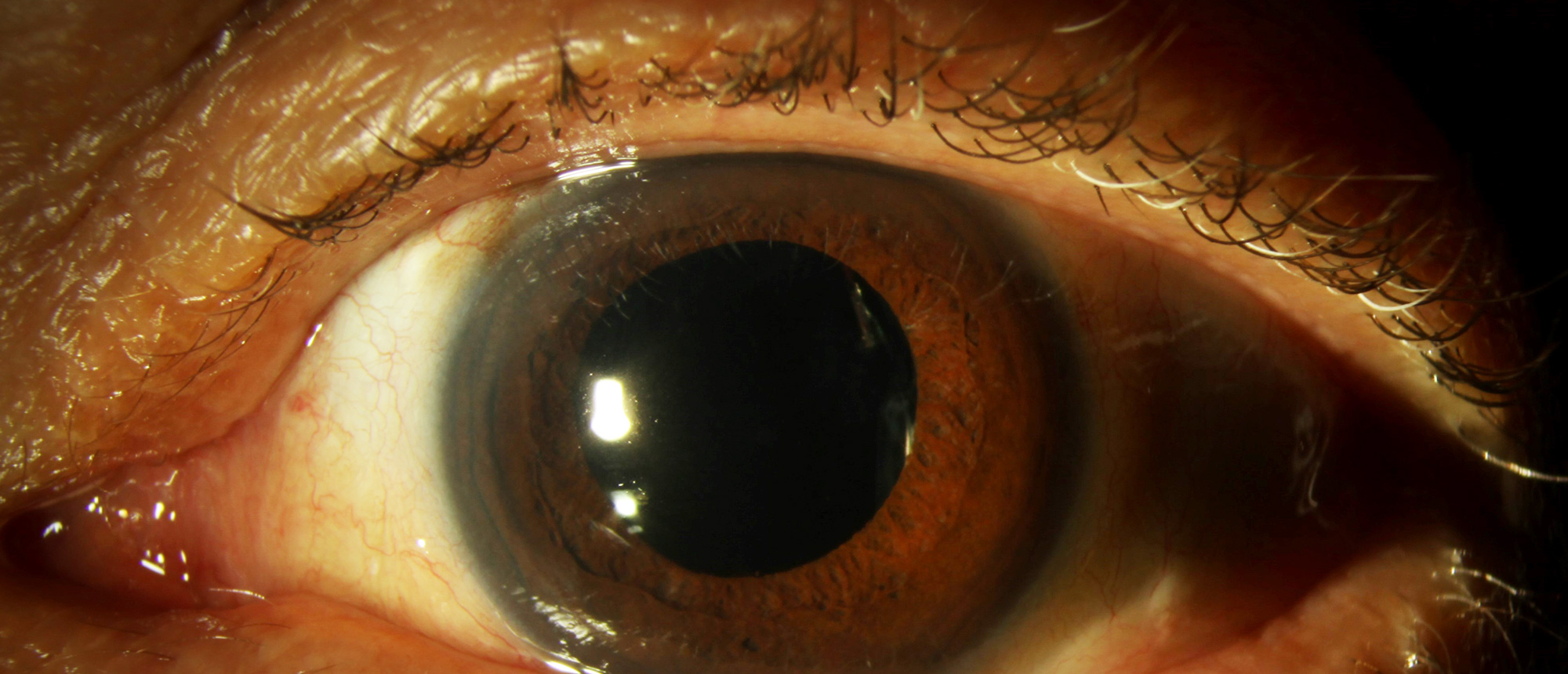 Extruded Scleral Buckle with Scleritis