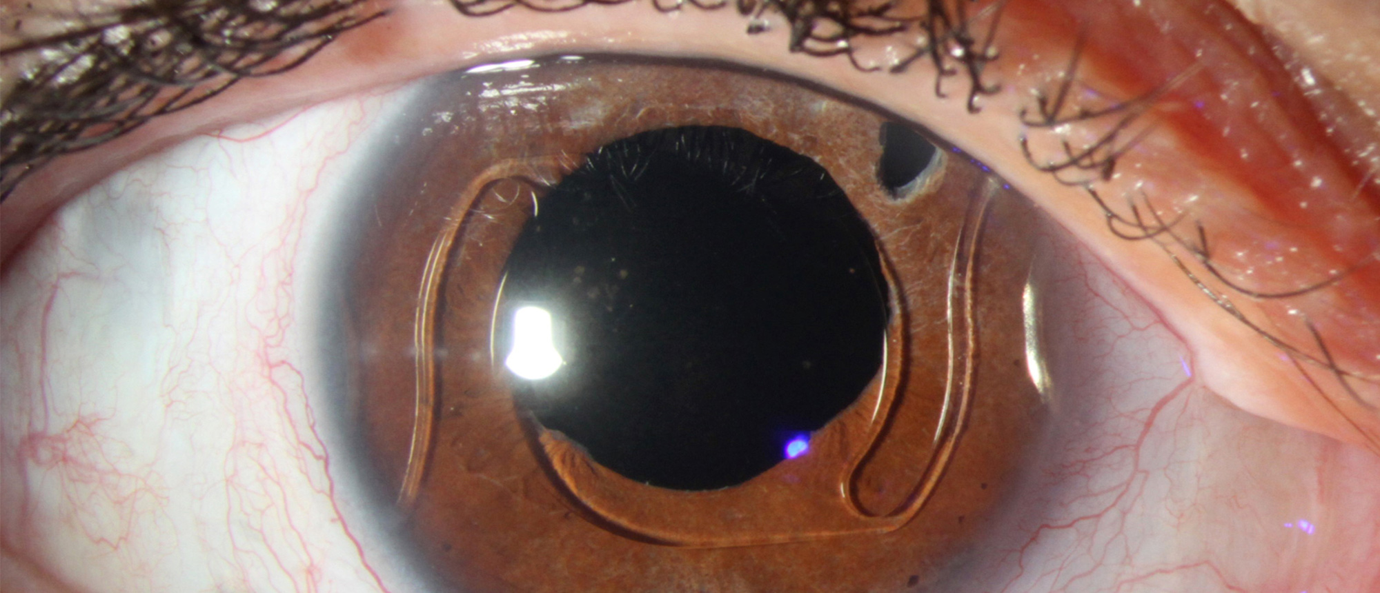 Anterior Chamber Intra-Ocular Lens