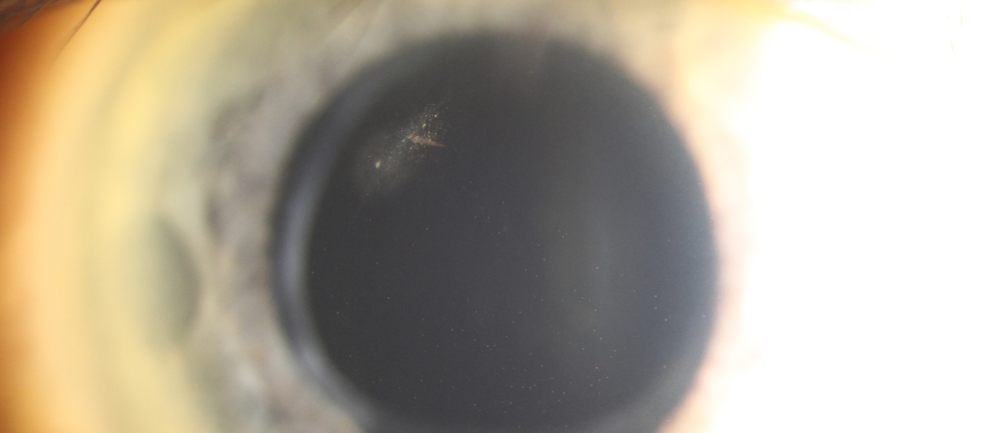 Bee Stinger in the Cornea