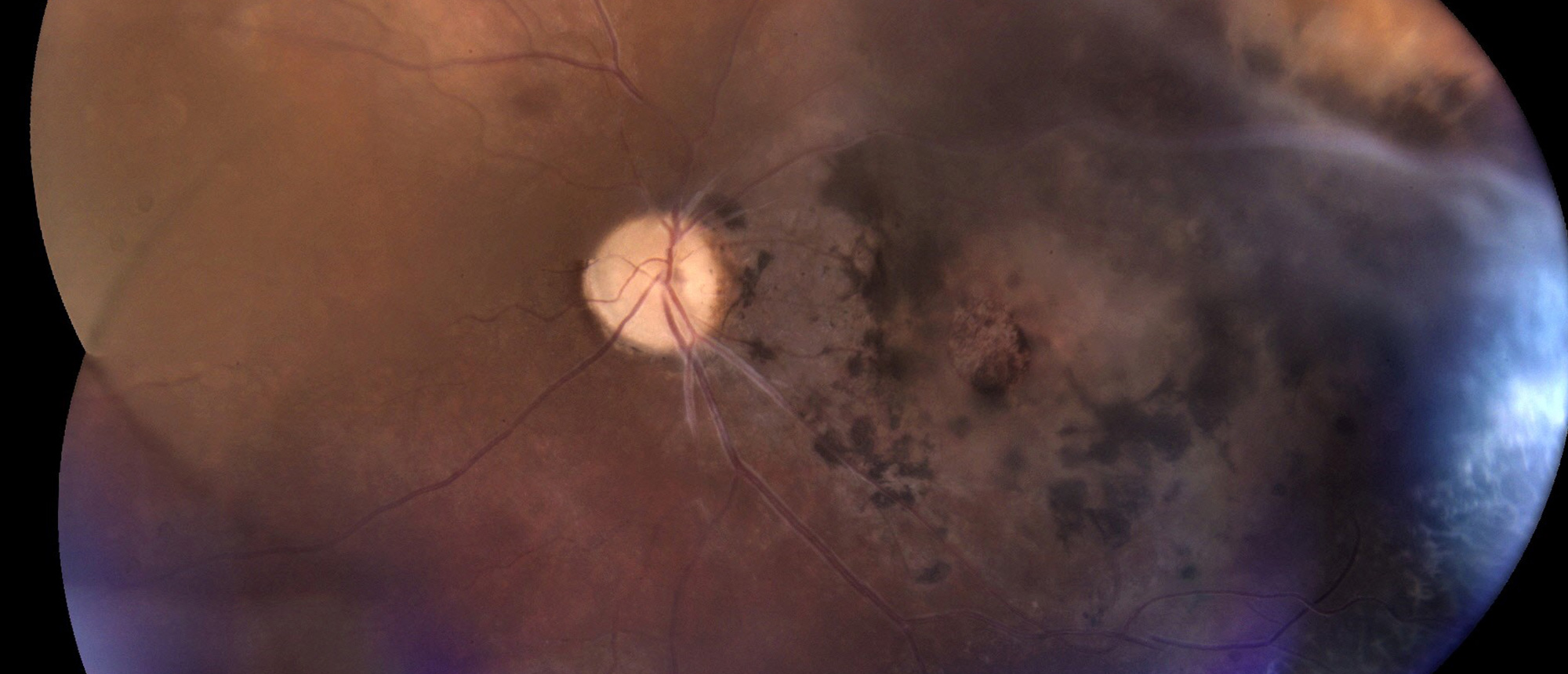 Chronic Macula Changes with Juvenile X-linked Retinoschisis