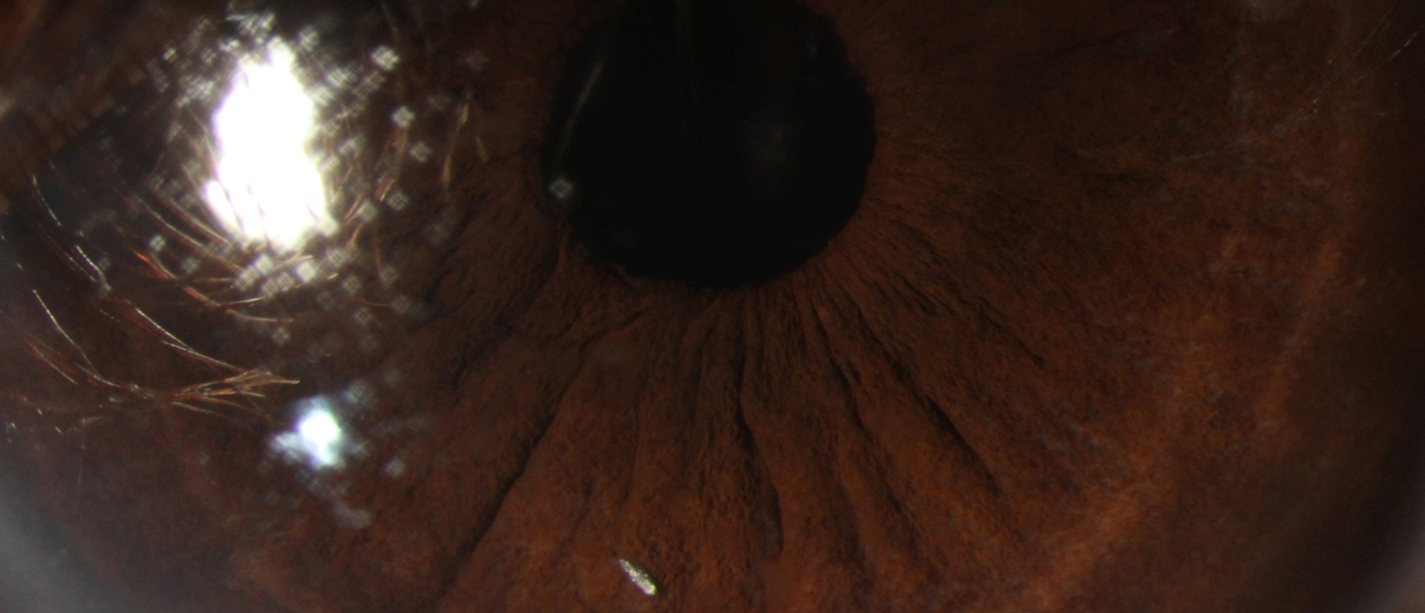 Metal Tip Post Phacoemulsification Surgery