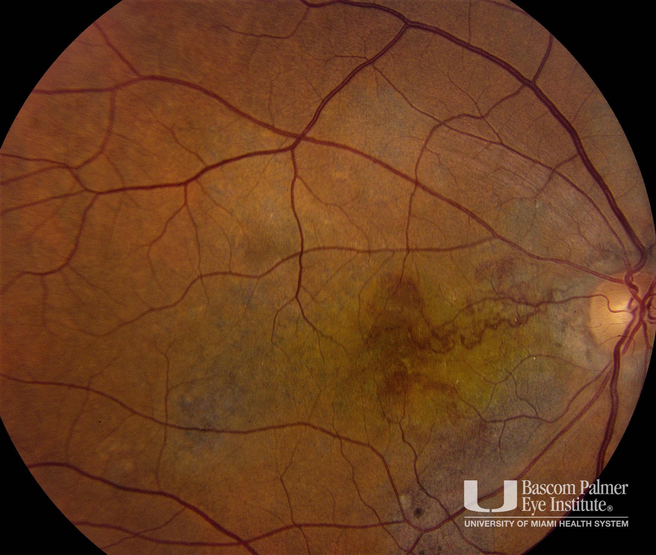 Central Serous Retinal with Choroidal Neovascularization