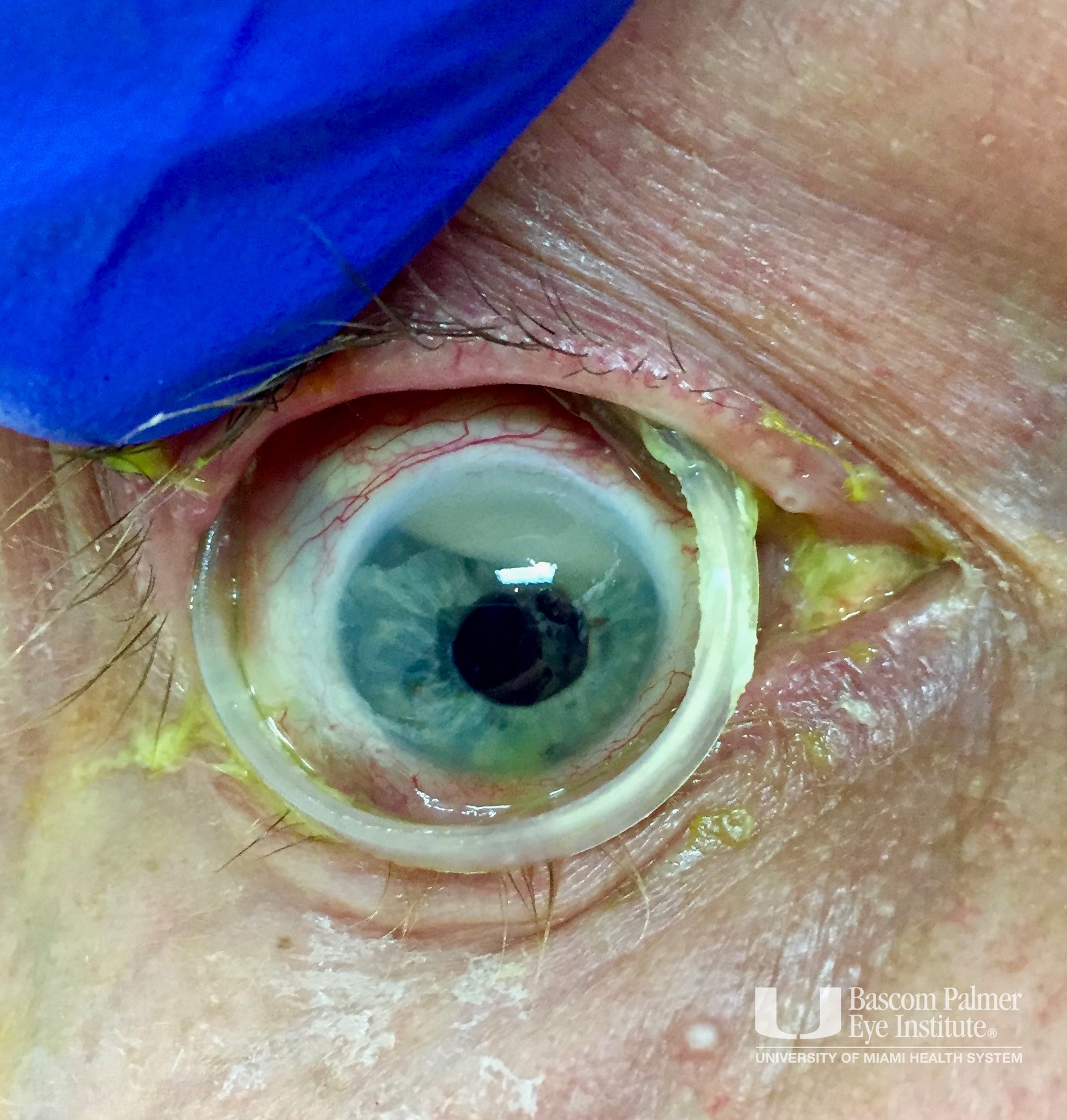 Extruded Scleral Buckle