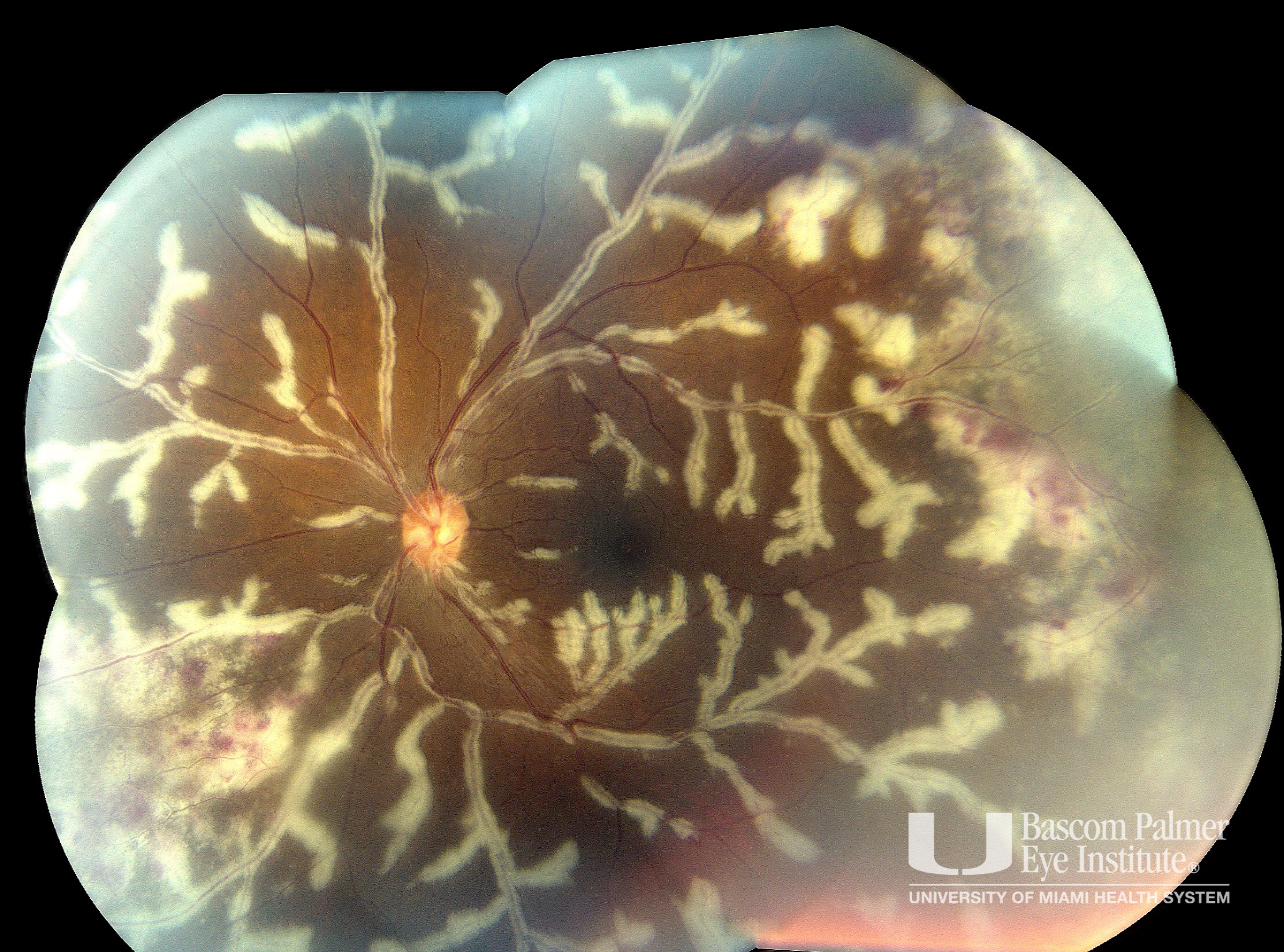 Cytomegalovirus Retinitis with Frosted Branch Angiitis