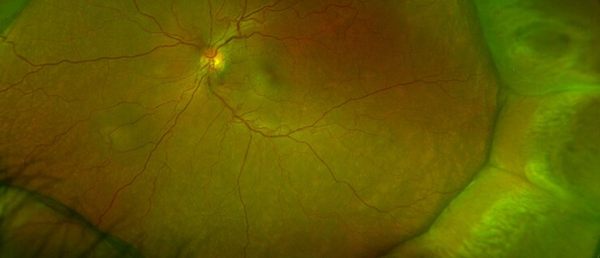 Bullous Central Serous Retinopathy with Choroidal Effusions