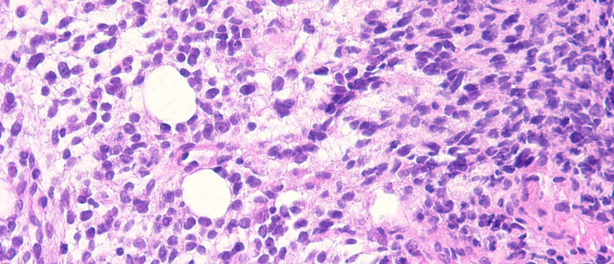 Rhabdomyosarcoma
