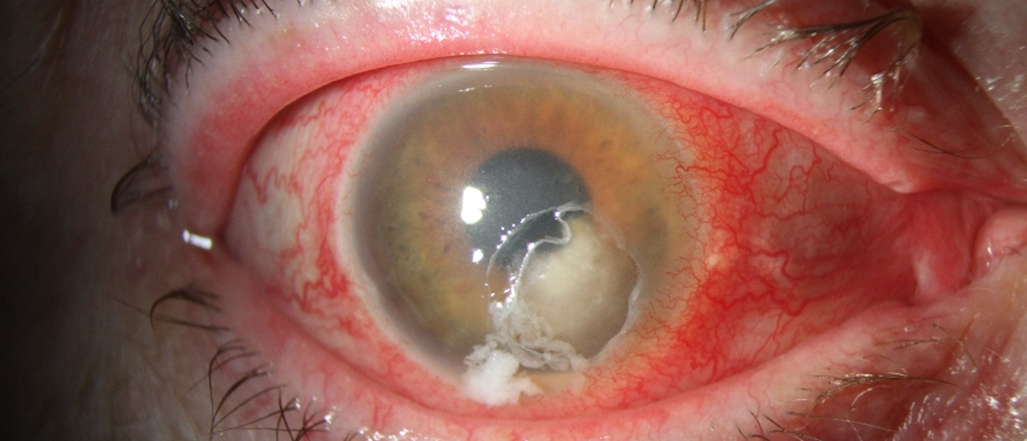 Mycobacterium Abscessus Keratitis