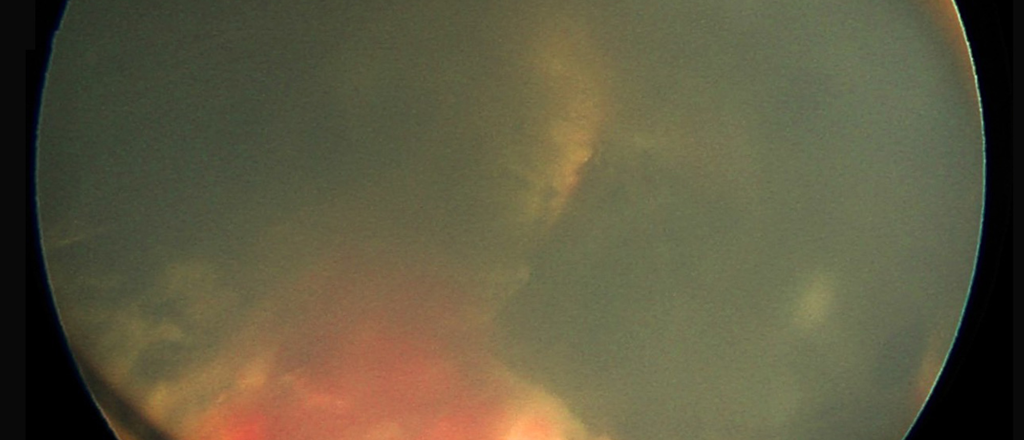 Vitreous Hemorrhage from X-linked Retinoschisis