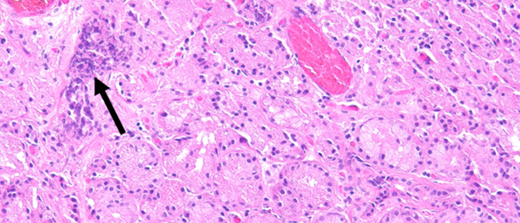 Granulomatosis with Polyangiitis