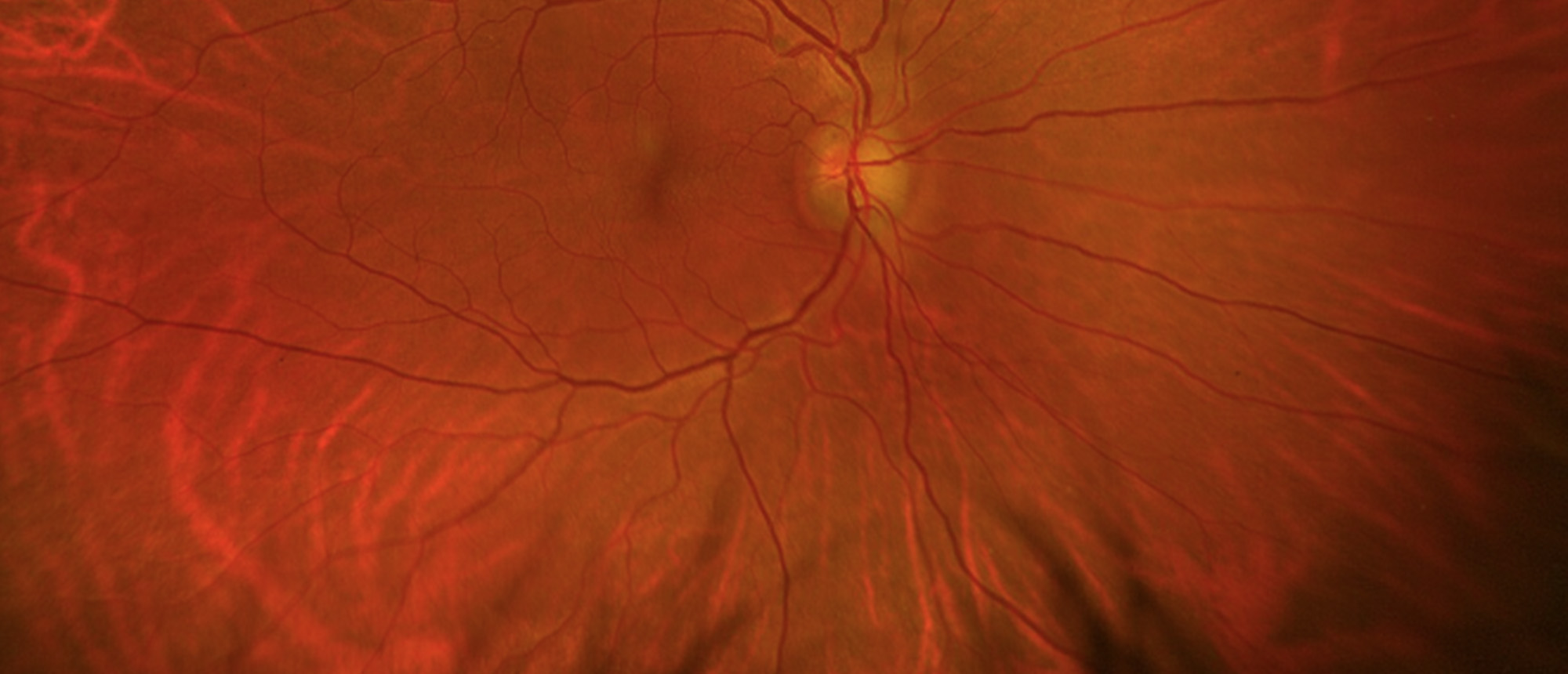 Giant Cell Arteritis