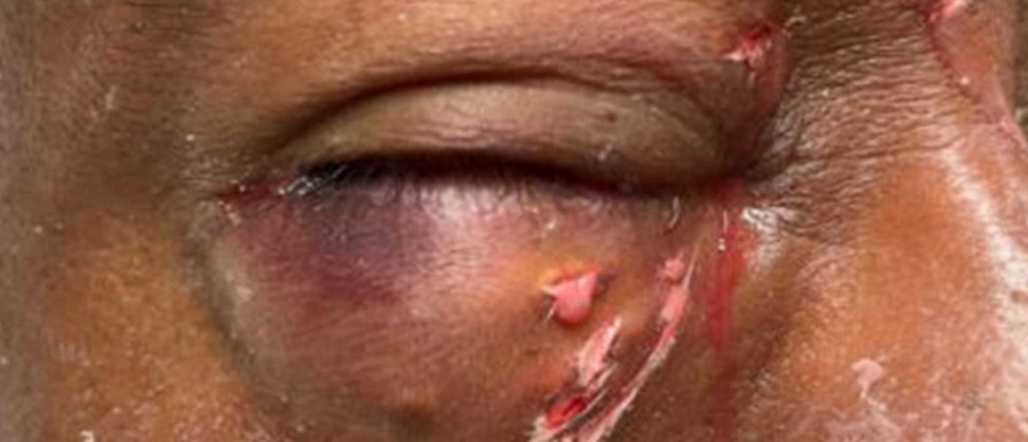 Chronic Orbital Inflammation Secondary to Paint Injury