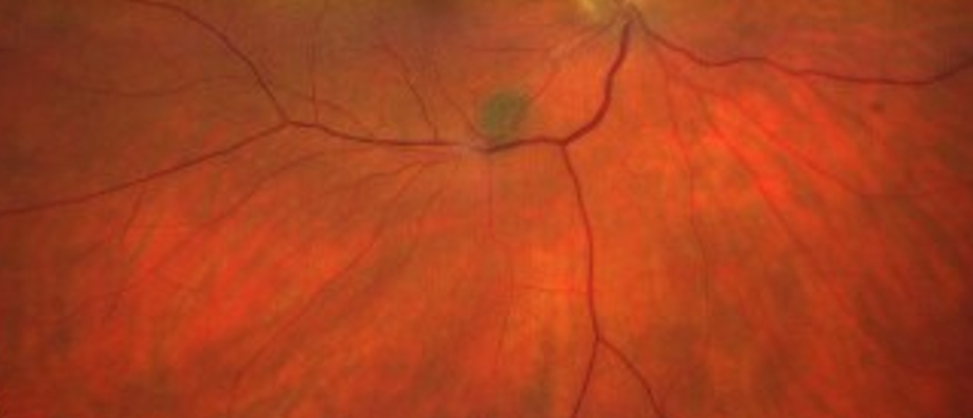 Squamous Cell Carcinoma with Perineural Spread