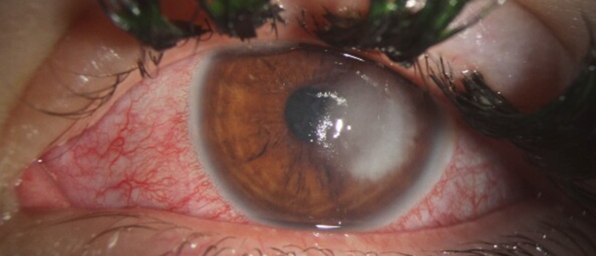 Fusarium Keratitis