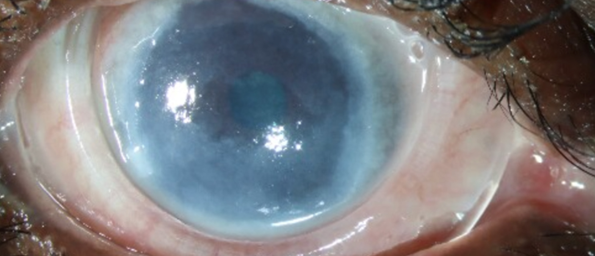 Paraneoplastic Mucous Membrane Pemphigoid