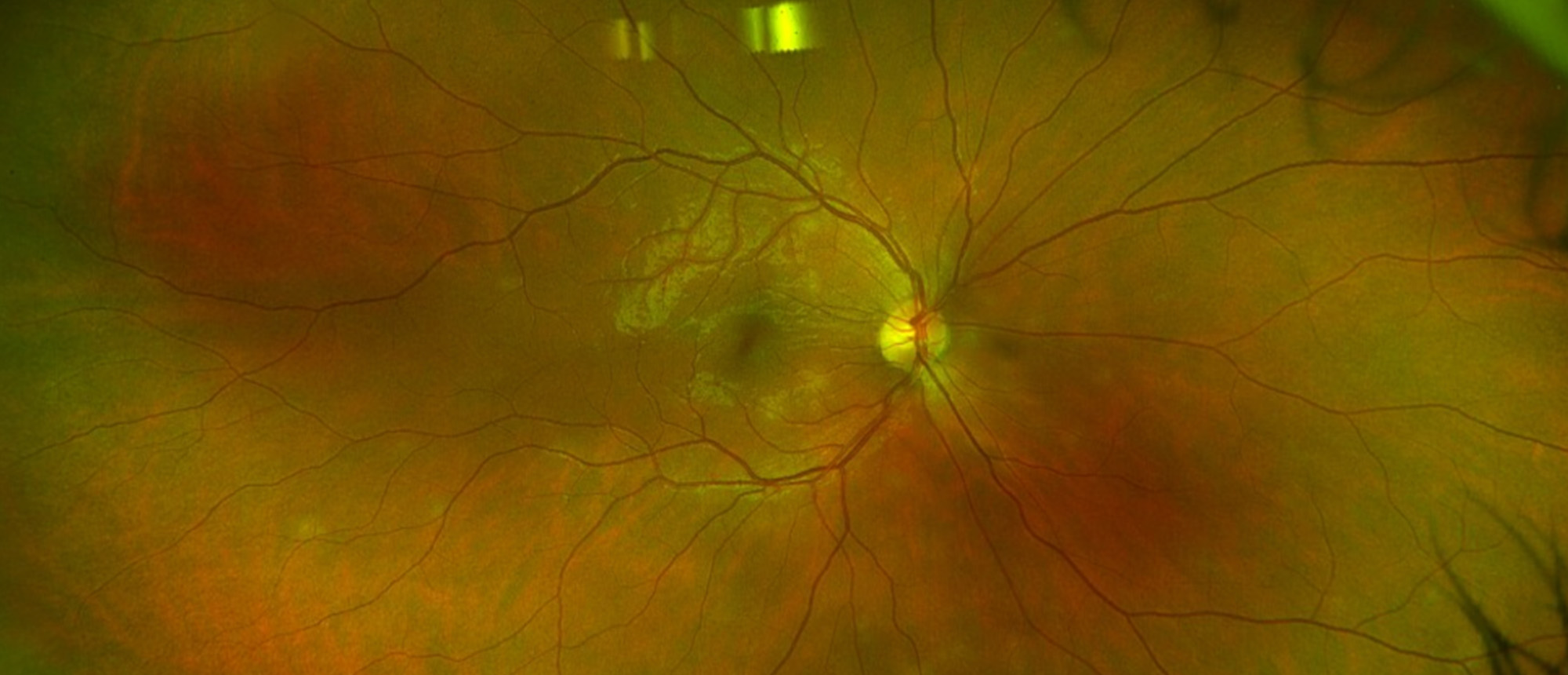 Acute Posterior Multifocal Placoid Pigment Epitheliopathy