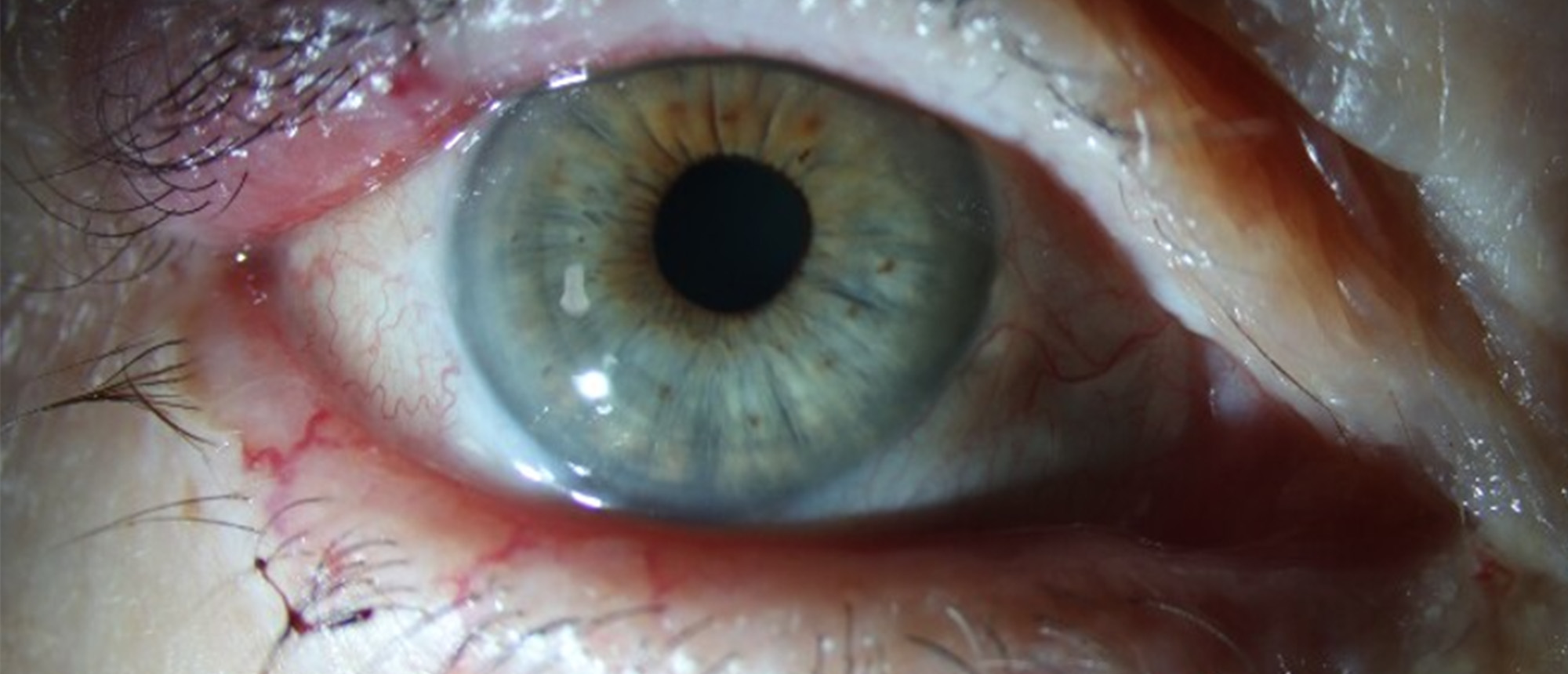 Hereditary Hemorrhagic Telangiectasia (Osler–Weber–Rendu Syndrome)